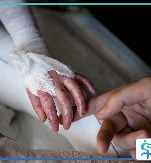 پرستار کودک پروانه ای در منزل