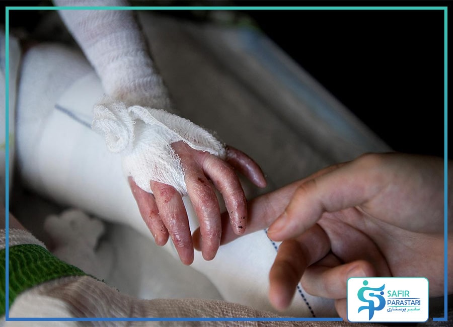 پرستار کودک پروانه ای در منزل